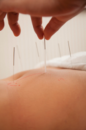 acupuncture therapy