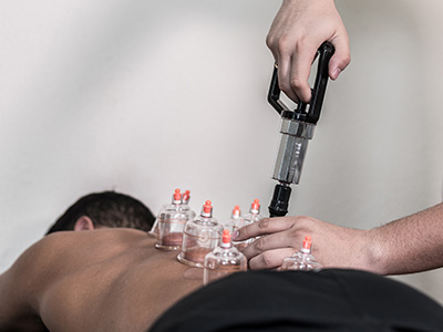 Cupping therapy by placing cups on the skin to create negative pressure suction, which causes mild acute inflammation, helping to improve blood flow, reduce muscle tension, and promote healing 